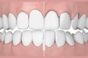 Неправильный прикус зубов – причины проблемы и её последствия