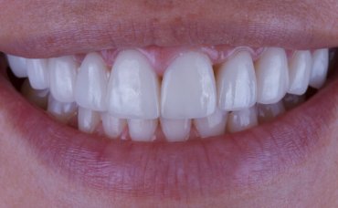 Виниры для зубов – красивая улыбка навсегда