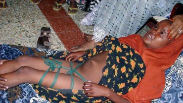 В Египте 12-летняя девочка умерла после ритуала обрезания