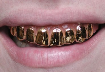 Зубные коронки: виды, характеристики и задачи