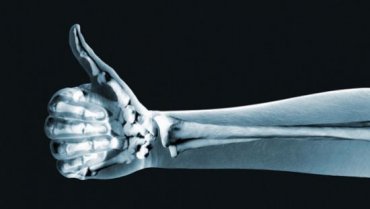 Ученые создали суперклей для костей