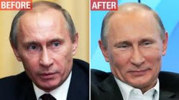 Врач подтвердил, что Путину делали пластическую операцию