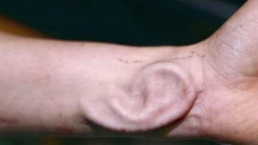 Китайские врачи вырастили новое ухо на руке пациента