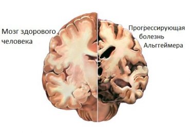 Ученые: Возможно найдено лекарство от Альцгеймера