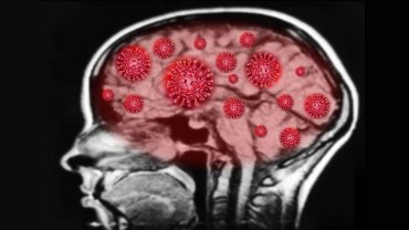 Дефекты мозга, как у больных Альцгеймера: ученые обнаружили аномалию у переболевших COVID-19
