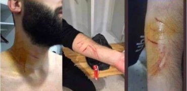 В матче чемпионата Турции футболист порезал соперников бритвой
