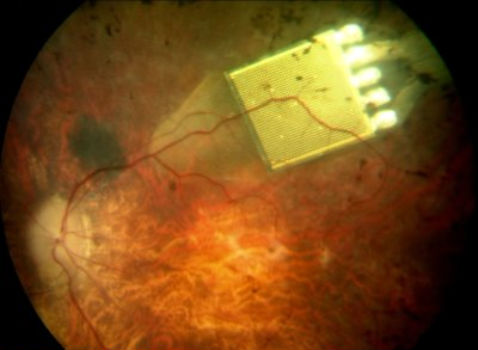 Прибор размещается позади сетчатки. Он использует свет, проходящий через глаз (в противовес альтернативным схемам с внешней камерой), чтобы формировать изображение 38 х 40 пикселей. Электрические сигналы через электроды подаются в зрительный нерв (фото Retina Implant).